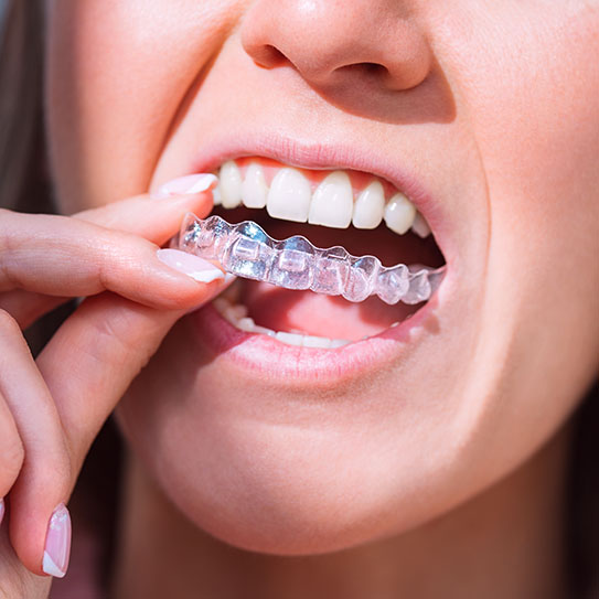 family dentist McKinney TX Invisalign